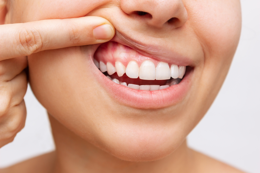 Closeup of a woman pulling up her upper lip to reveal health gums after laser gum therapy, dentist in Hot Springs Village