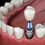 dental implant candidate, dental implants, oral health, bone density, Lefler Dental, Hot Springs Village dentist, Dr. Thomas Lefler, Dr. Josie Goodman