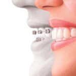 woman in profile comparing traditional braces and clear aligners