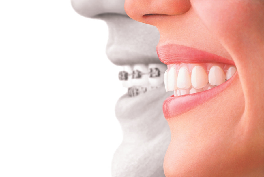 woman in profile comparing traditional braces and clear aligners