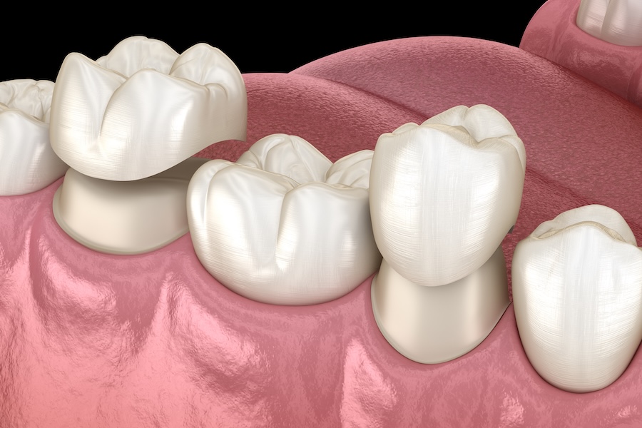 comparing dental crowns or veneers