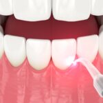 dental laser performing laser gum treatment or laser gum therapy