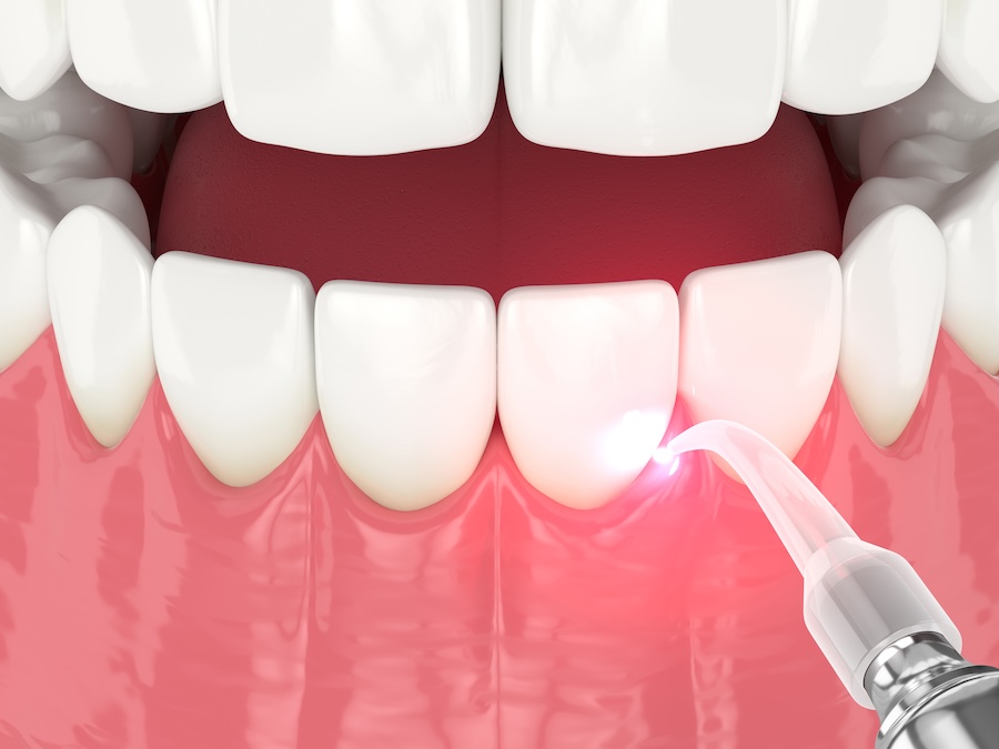 dental laser performing laser gum treatment or laser gum therapy
