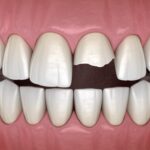 broken front tooth after dental trauma that would benefit from treatment by a prosthodontist after dental trauma