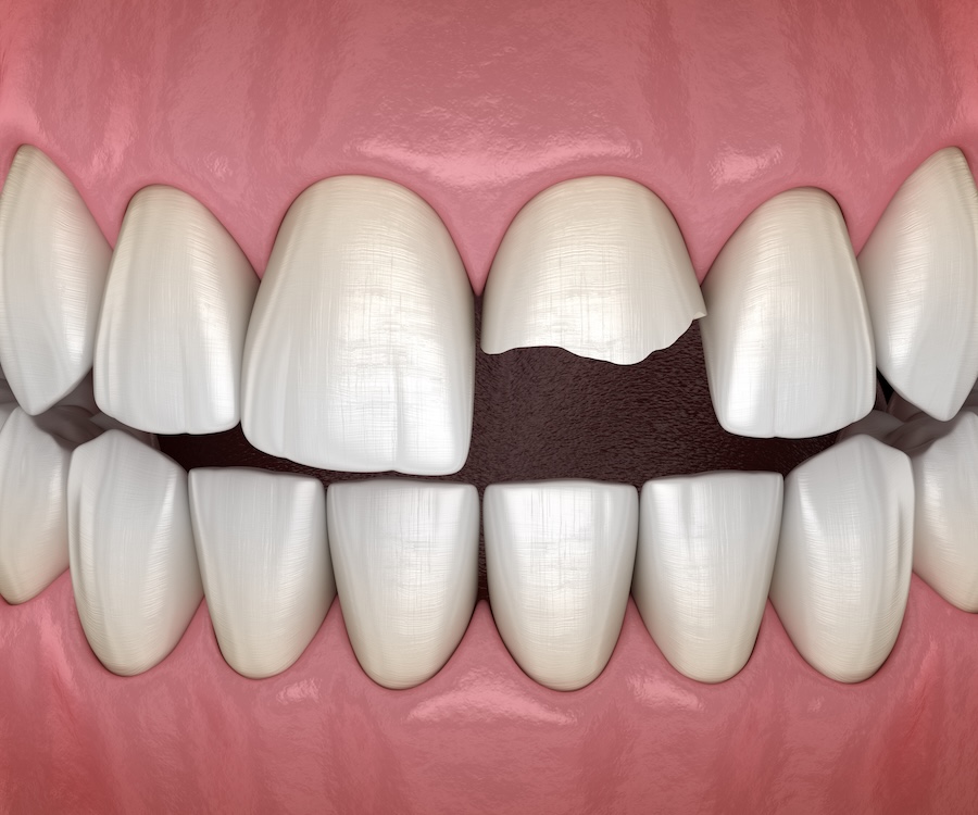 broken front tooth after dental trauma that would benefit from treatment by a prosthodontist after dental trauma