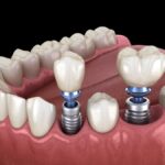 dental implants