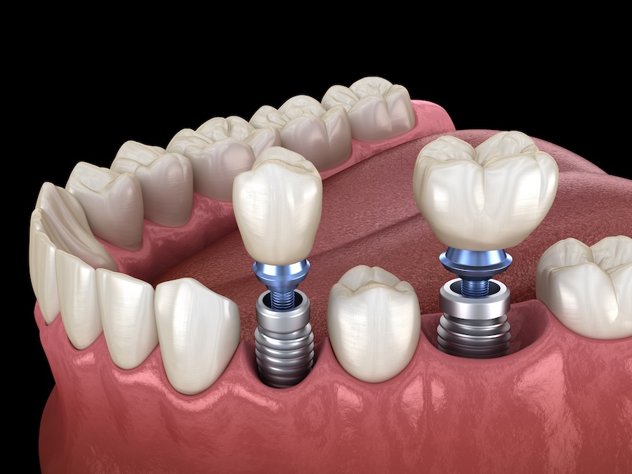 dental implants